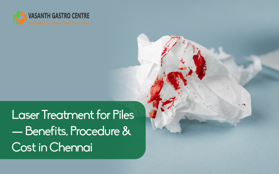 Laser Treatment for Piles - Benefits, Procedure & Cost in Chennai