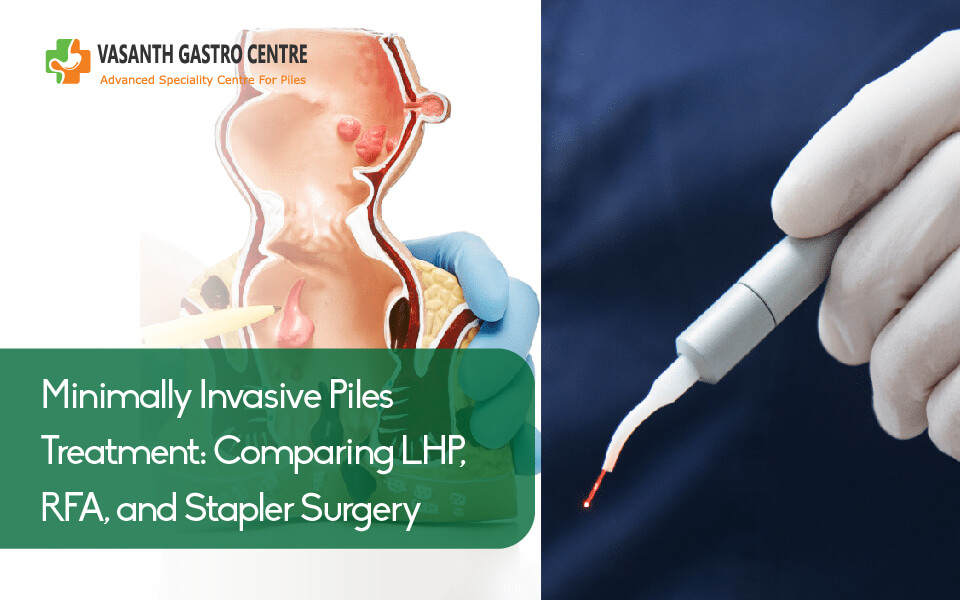 Minimally invasive piles treatment LHP RFA Stapler