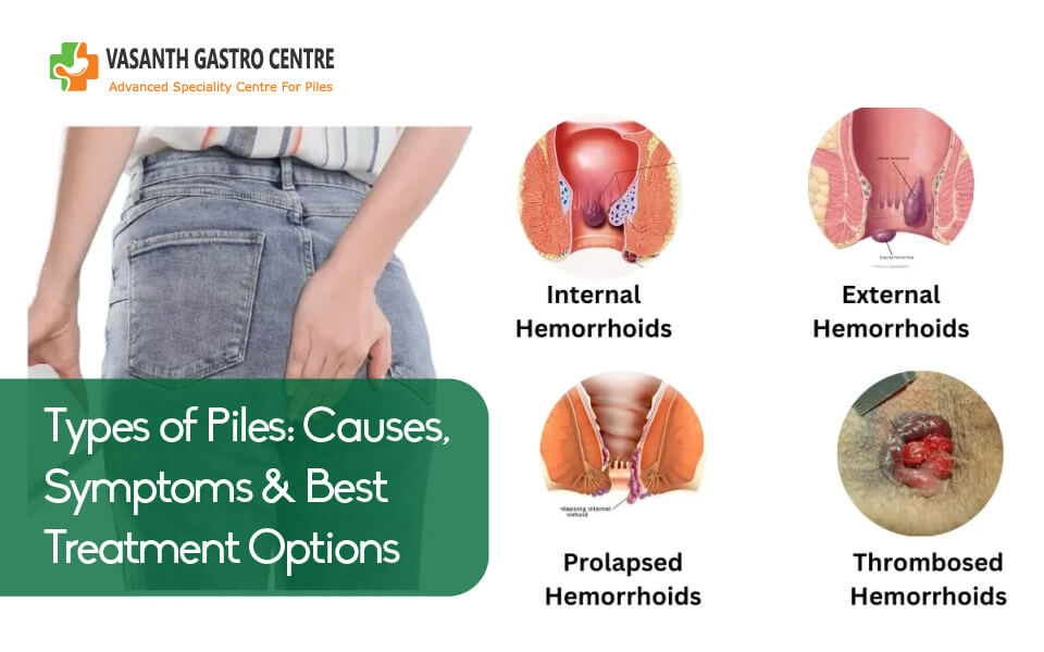 Types of Piles - Internal, External and Thrombosed